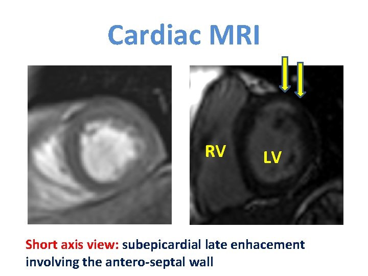 Cardiac MRI RV LV Short axis view: subepicardial late enhacement involving the antero-septal wall