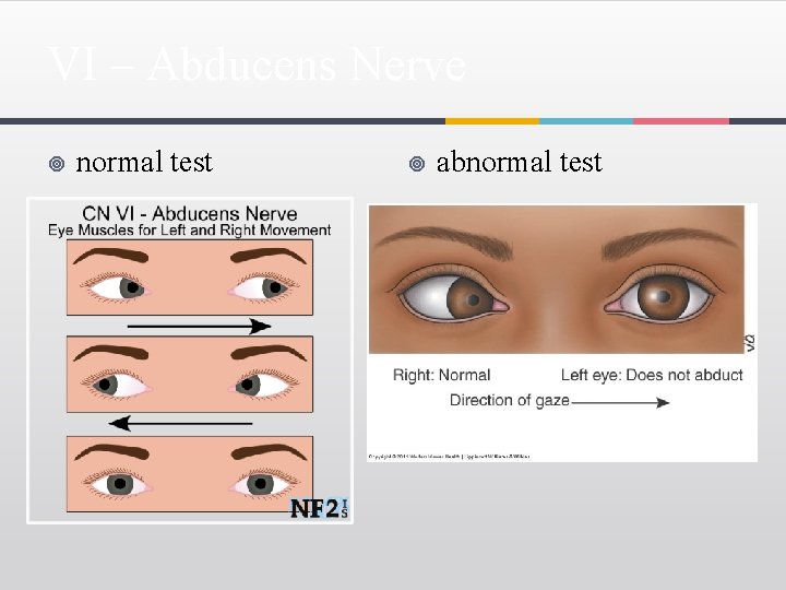 VI – Abducens Nerve ¥ normal test ¥ abnormal test 