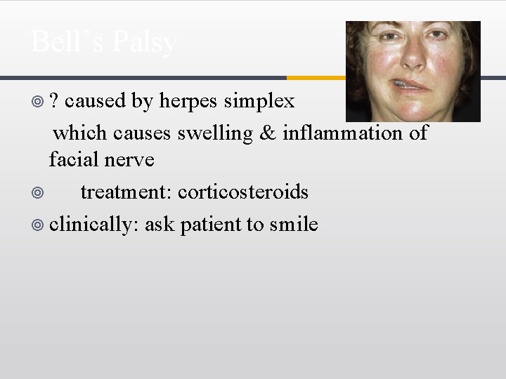 Bell’s Palsy ¥? caused by herpes simplex which causes swelling & inflammation of facial