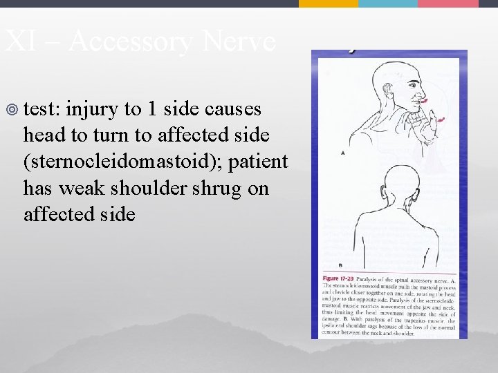 XI – Accessory Nerve ¥ test: injury to 1 side causes head to turn