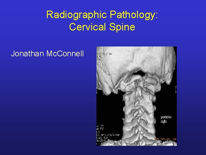 Radiographic Pathology: Cervical Spine Jonathan Mc. Connell 