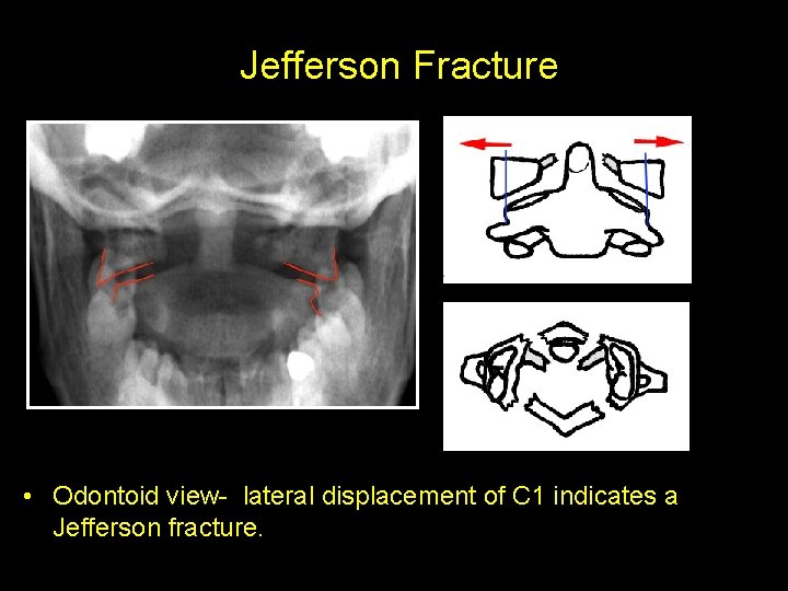 Jefferson Fracture • Odontoid view- lateral displacement of C 1 indicates a Jefferson fracture.