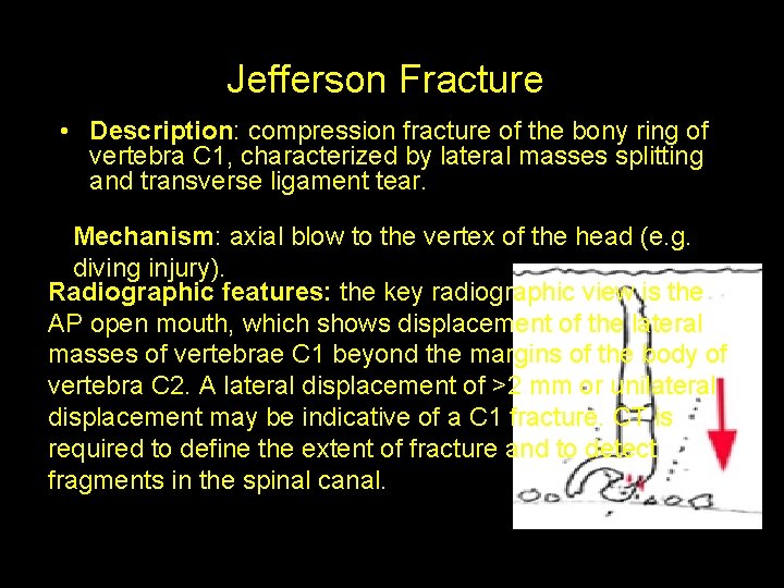 Jefferson Fracture • Description: compression fracture of the bony ring of vertebra C 1,