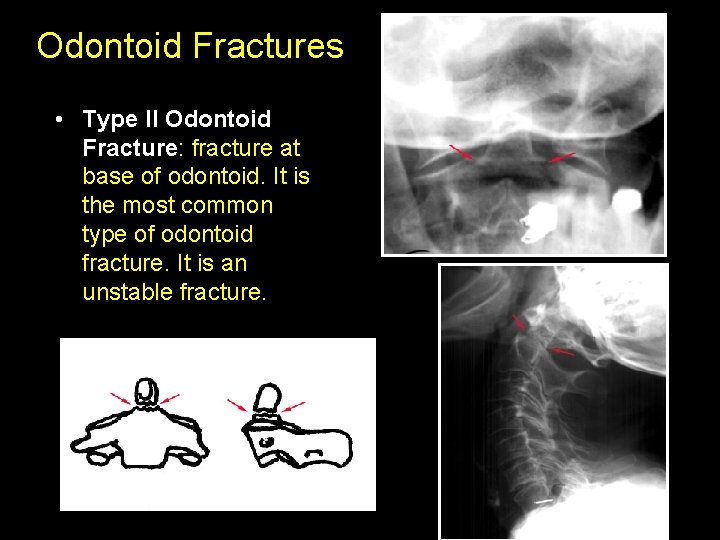 Odontoid Fractures • Type II Odontoid Fracture: fracture at base of odontoid. It is