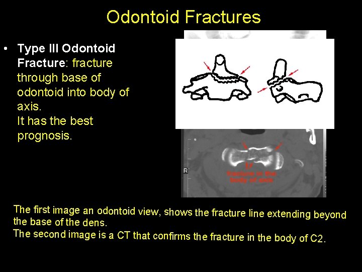 Odontoid Fractures • Type III Odontoid Fracture: fracture through base of odontoid into body