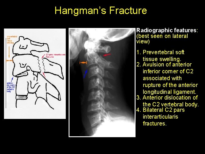 Hangman’s Fracture • Radiographic features: (best seen on lateral view) 1. Prevertebral soft tissue