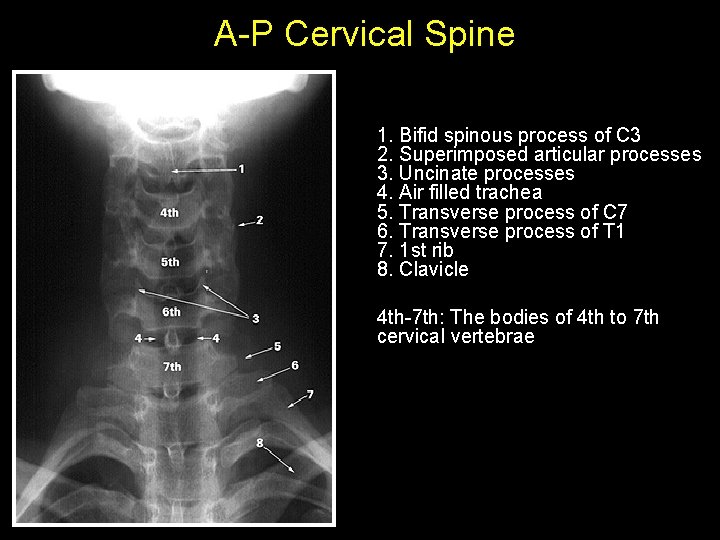 A-P Cervical Spine 1. Bifid spinous process of C 3 2. Superimposed articular processes