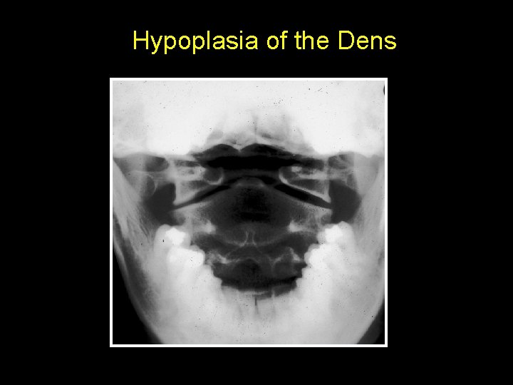 Hypoplasia of the Dens 