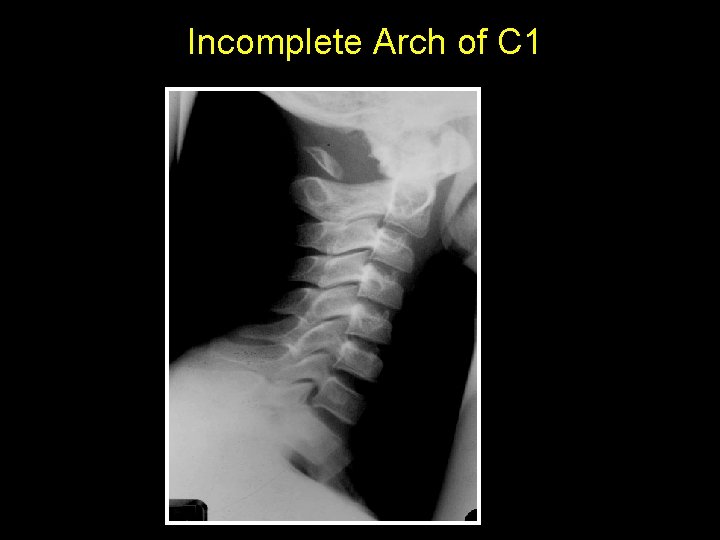 Incomplete Arch of C 1 