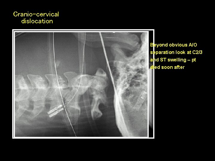 Cranio-cervical dislocation Beyond obvious A/O separation look at C 2/3 and ST swelling –