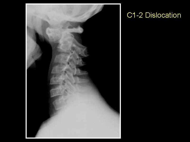C 1 -2 Dislocation 
