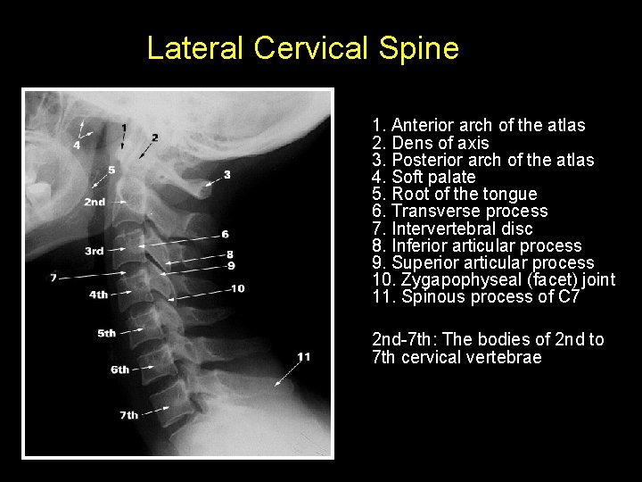 Lateral Cervical Spine 1. Anterior arch of the atlas 2. Dens of axis 3.