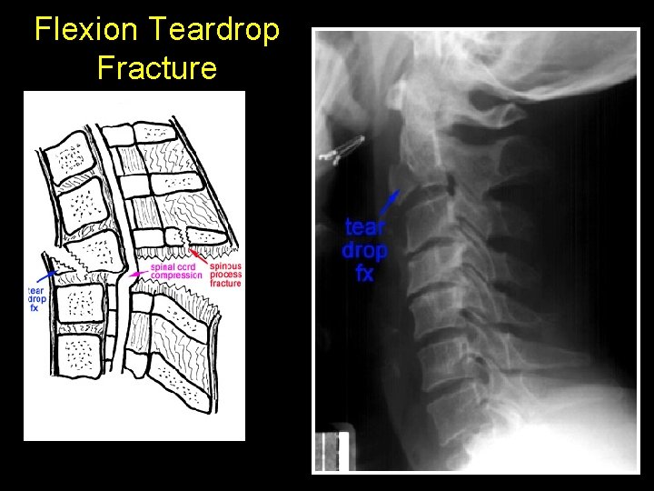 Flexion Teardrop Fracture 