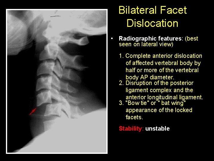 Bilateral Facet Dislocation • Radiographic features: (best seen on lateral view) 1. Complete anterior