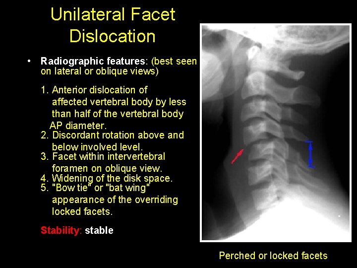 Unilateral Facet Dislocation • Radiographic features: (best seen on lateral or oblique views) 1.