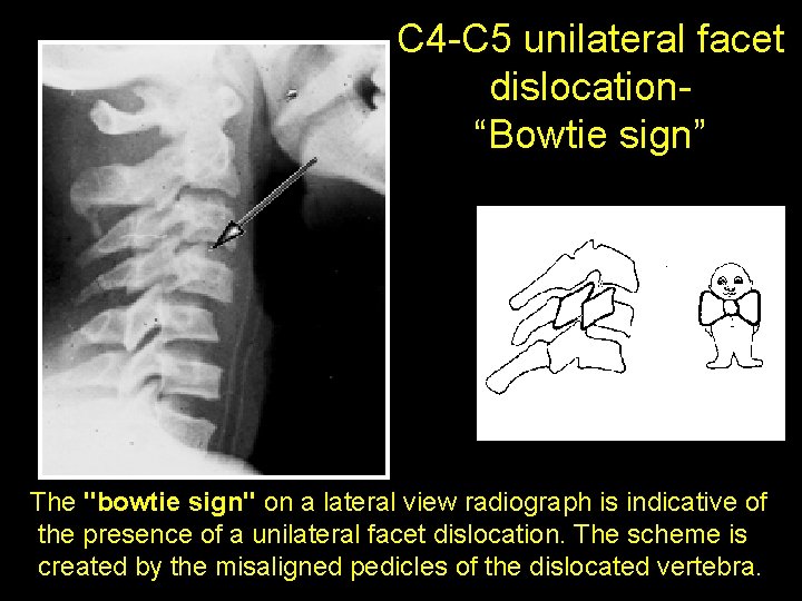 C 4 -C 5 unilateral facet dislocation“Bowtie sign” The "bowtie sign" on a lateral