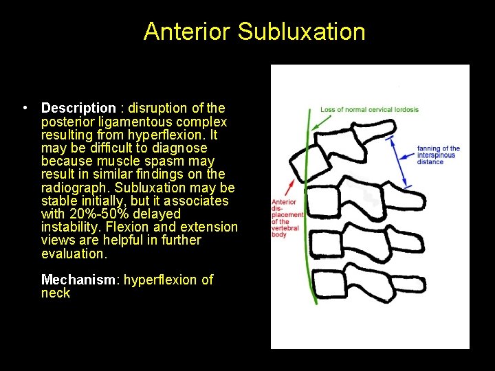 Anterior Subluxation • Description : disruption of the posterior ligamentous complex resulting from hyperflexion.