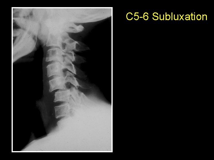 C 5 -6 Subluxation 