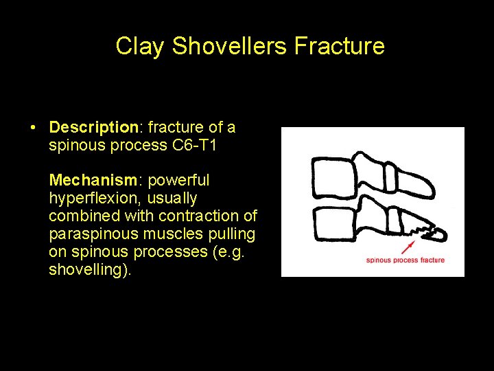 Clay Shovellers Fracture • Description: fracture of a spinous process C 6 -T 1