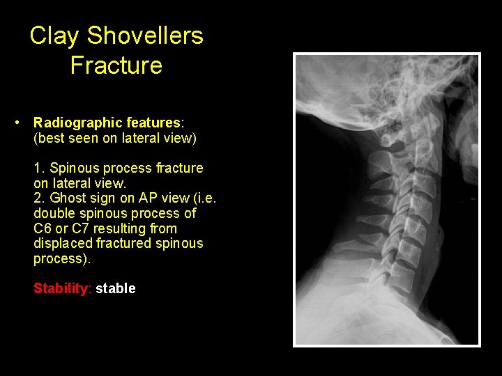 Clay Shovellers Fracture • Radiographic features: (best seen on lateral view) 1. Spinous process