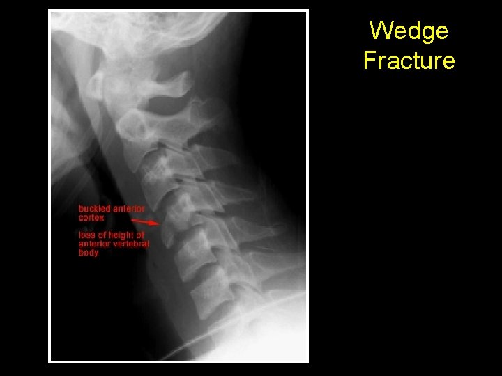 Wedge Fracture 