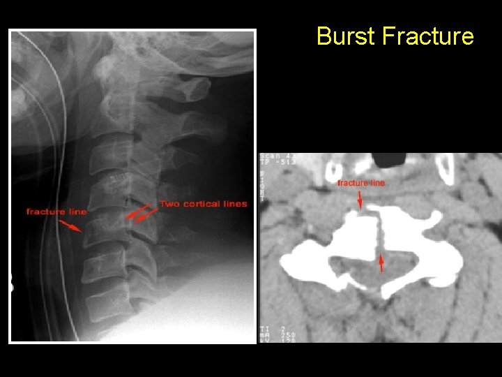 Burst Fracture 