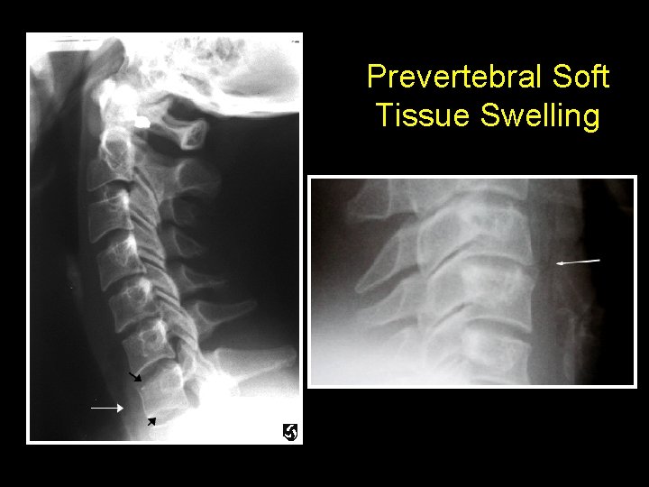 Prevertebral Soft Tissue Swelling 