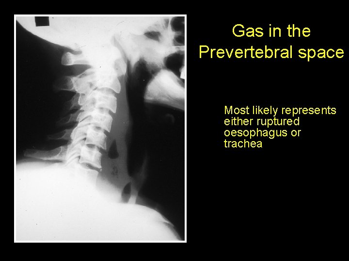 Gas in the Prevertebral space Most likely represents either ruptured oesophagus or trachea 