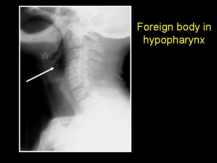 Foreign body in hypopharynx 