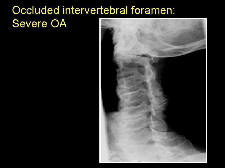 Occluded intervertebral foramen: Severe OA 