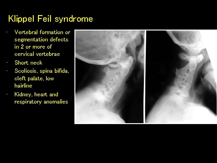 Klippel Feil syndrome • • Vertebral formation or segmentation defects in 2 or more