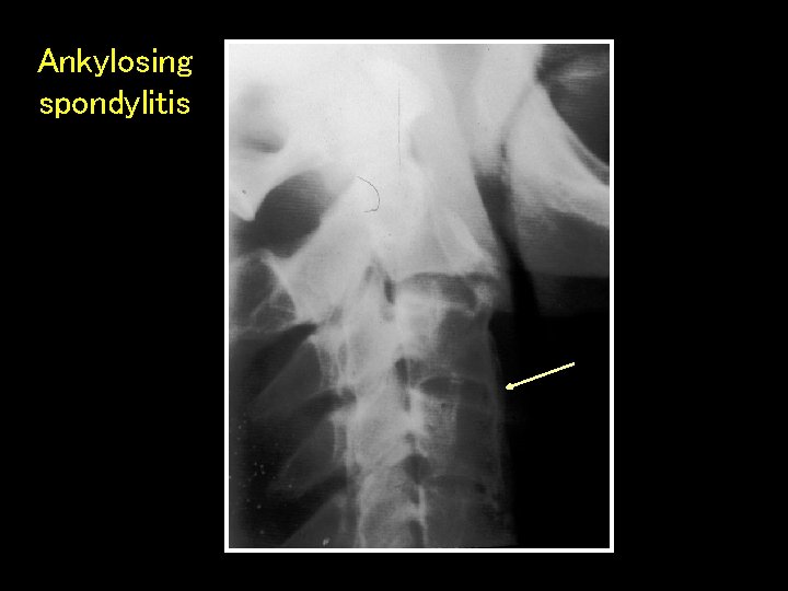 Ankylosing spondylitis 
