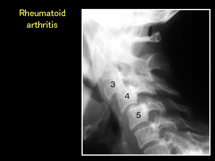 Rheumatoid arthritis 