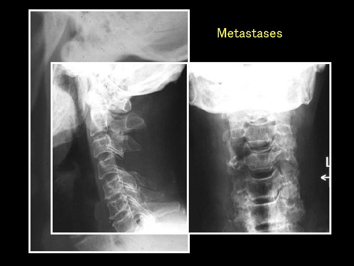 Metastases 