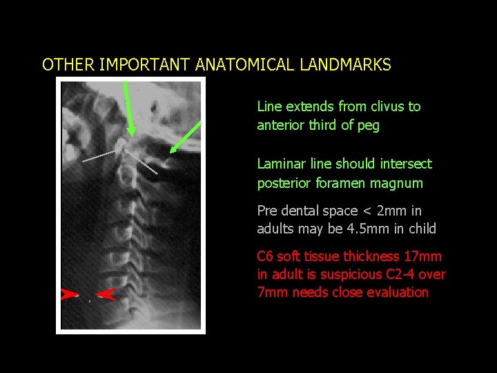 OTHER IMPORTANT ANATOMICAL LANDMARKS Line extends from clivus to anterior third of peg Laminar