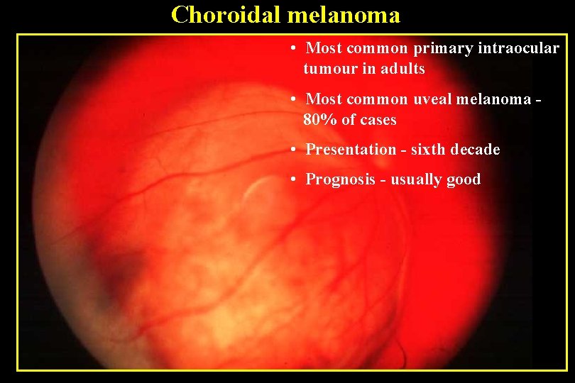 Choroidal melanoma • Most common primary intraocular tumour in adults • Most common uveal