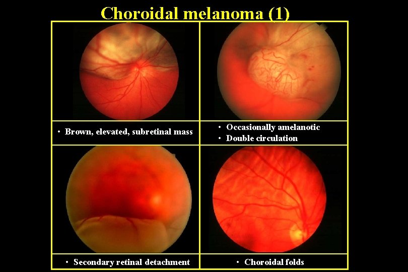 Choroidal melanoma (1) • Brown, elevated, subretinal mass • Occasionally amelanotic • Double circulation