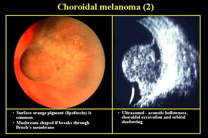 Choroidal melanoma (2) • Surface orange pigment (lipofuscin) is common • Mushroom-shaped if breaks