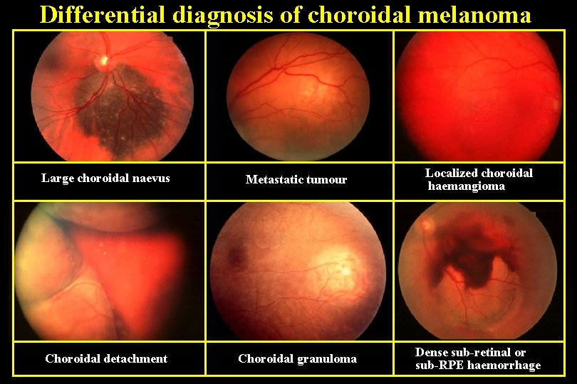 Differential diagnosis of choroidal melanoma Large choroidal naevus Metastatic tumour Localized choroidal haemangioma Choroidal