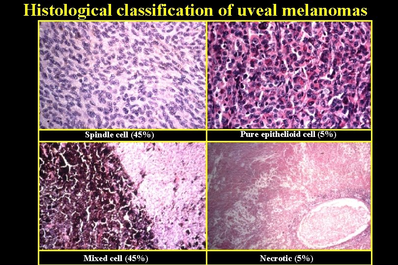 Histological classification of uveal melanomas Spindle cell (45%) Mixed cell (45%) Pure epithelioid cell