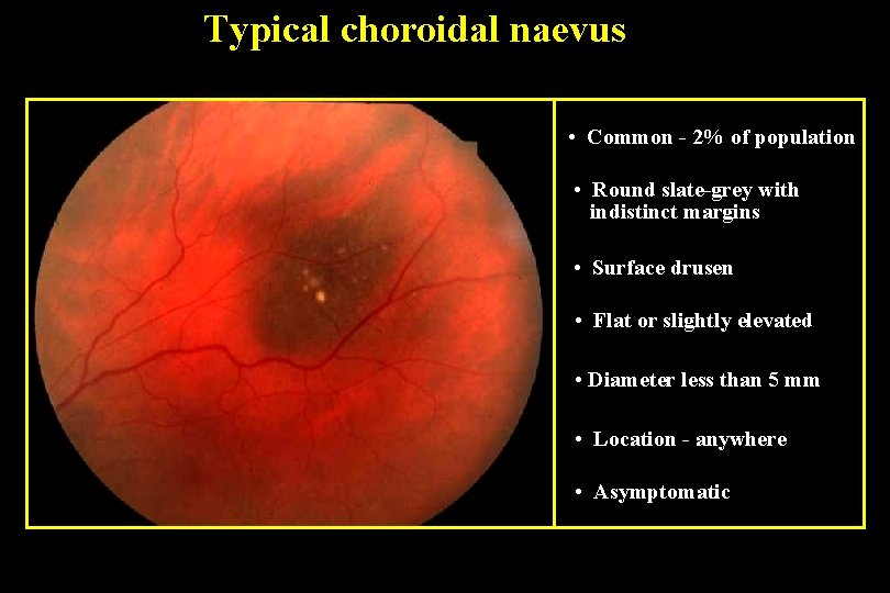 Typical choroidal naevus • Common - 2% of population • Round slate-grey with indistinct