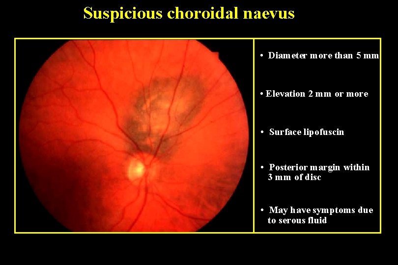 Suspicious choroidal naevus • Diameter more than 5 mm • Elevation 2 mm or