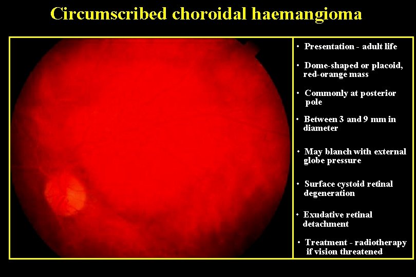 Circumscribed choroidal haemangioma • Presentation - adult life • Dome-shaped or placoid, red-orange mass