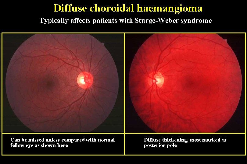 Diffuse choroidal haemangioma Typically affects patients with Sturge-Weber syndrome Can be missed unless compared