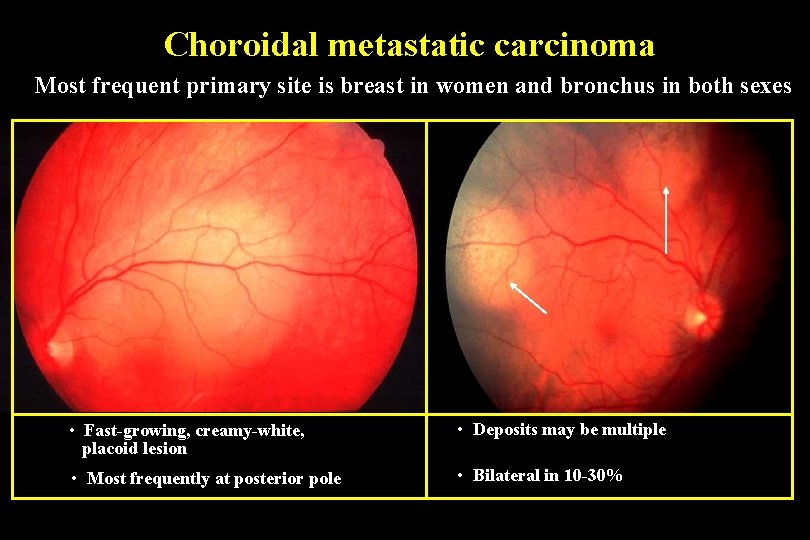 Choroidal metastatic carcinoma Most frequent primary site is breast in women and bronchus in