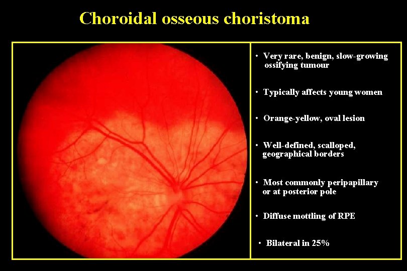 Choroidal osseous choristoma • Very rare, benign, slow-growing ossifying tumour • Typically affects young