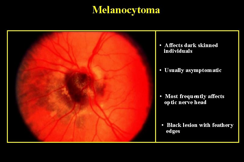 Melanocytoma • Affects dark skinned individuals • Usually asymptomatic • Most frequently affects optic