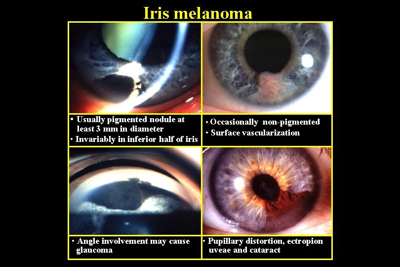 Iris melanoma • Usually pigmented nodule at • Occasionally non-pigmented least 3 mm in
