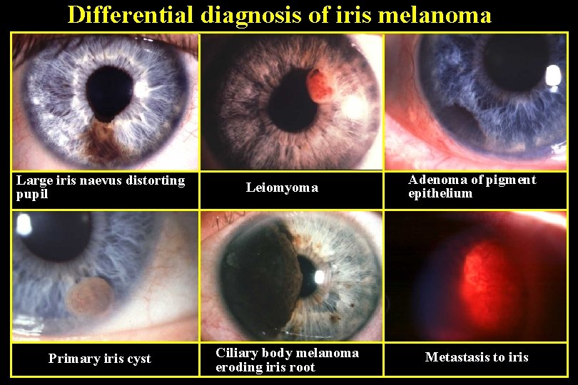 Differential diagnosis of iris melanoma Large iris naevus distorting pupil Primary iris cyst Leiomyoma