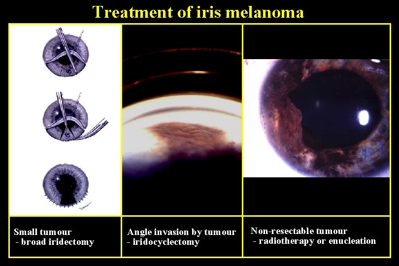 Treatment of iris melanoma Small tumour - broad iridectomy Angle invasion by tumour -